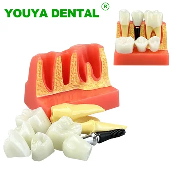 שיניים מודל הדרכה 4 פעמים שתל שיניים בניתוח כתר גשר נשלף דגם רפואת שיניים מדע הרפואה הוראה למידה